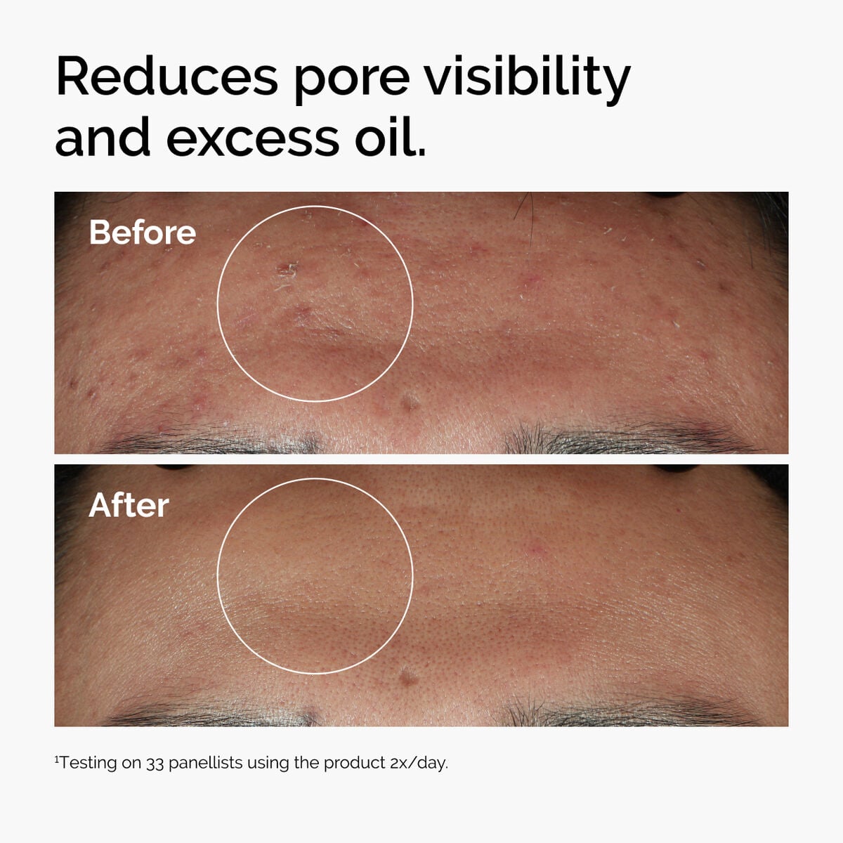 niacinamide-10-zinc-1-j8 ord-niacinamide-zinc-blemish-serum-before-after-pores.jpg