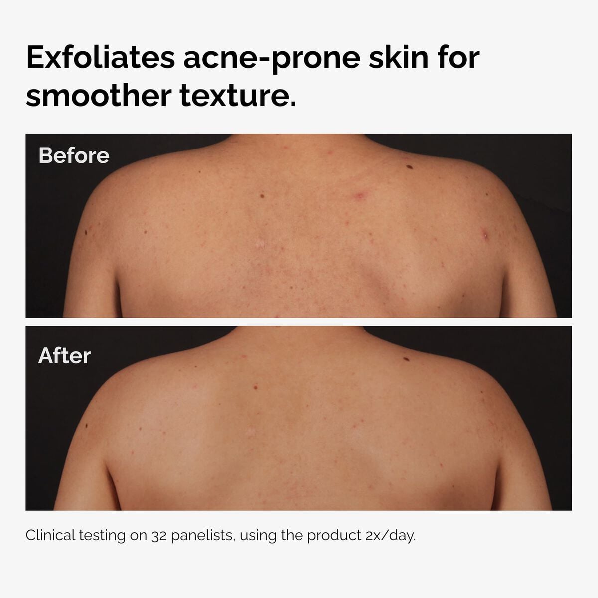 salicylic-acid-0-5-body-serum-s8 ord-salicylic-acid-body-serum-before-after-graphic-NA.jpg